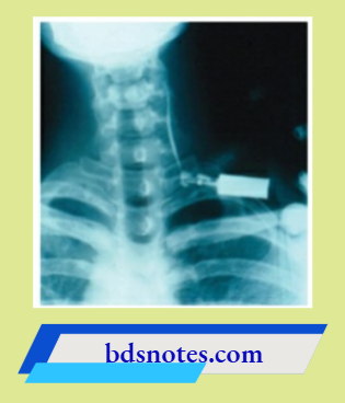 Contrast Study Demonstrating Fistulous Tract