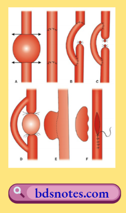 Different Methods Of Operation For Aneurysm