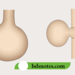End Neuroma Overview