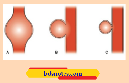 Fusiform And Saccular And False Aneurysm
