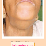 Level 1 And 2 Nodes. Carcinoma Floor Of The Mouth