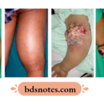 Liposarcoma Overview