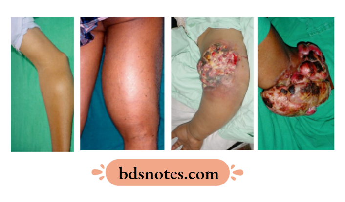 Liposarcoma Overview