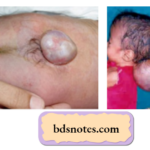 Meningocele Overview