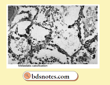 Metastatic Calcification Pathology