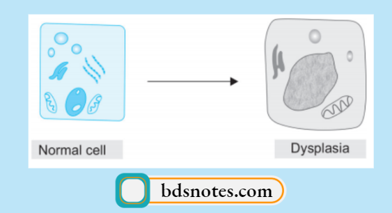 Normal Cell vs Dysplasia Comparison