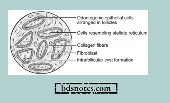 Odontogenic Epithelial Follicles Stellate Reticulum