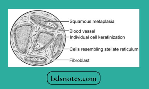 Squamous Metaplasia Keratinization Histology