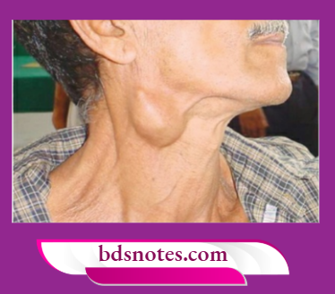 Swelling Mimicked Branchial Cyst