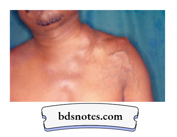 Synovial Sarcoma vs Other Sarcomas