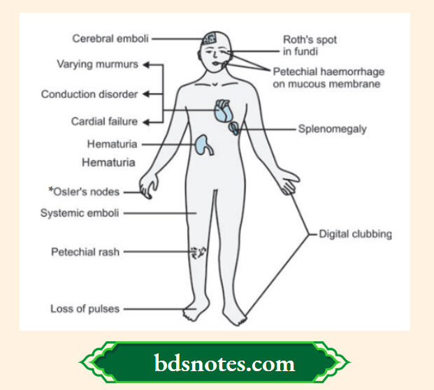 The clinical signs of SABE
