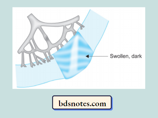 Tissue Swelling Dark Discoloration