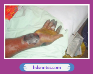 Gangrenem - Definition, Classification, Signs Notes - BDS Notes