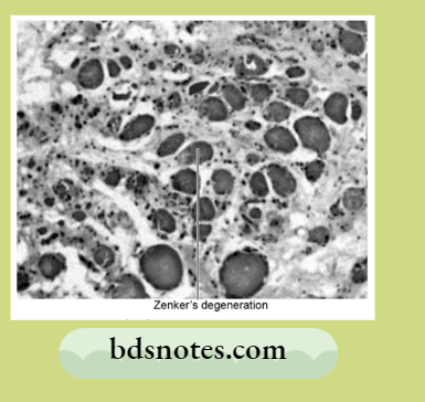 Zenkers Degeneration Skeletal Muscle
