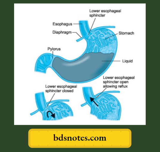 gastroesophageal reflux 