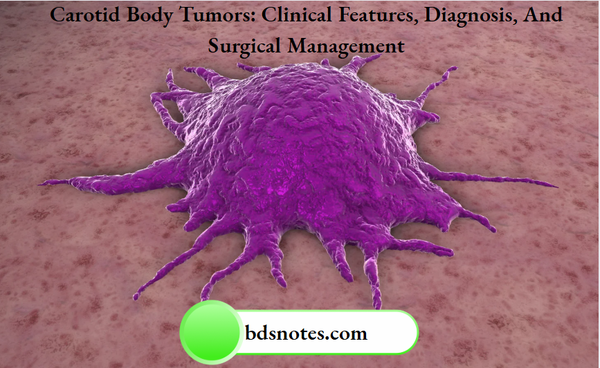 Carotid Body Tumors Clinical Features, Diagnosis, And Surgical Management