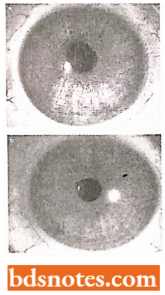 Heterochromia Of The Iris