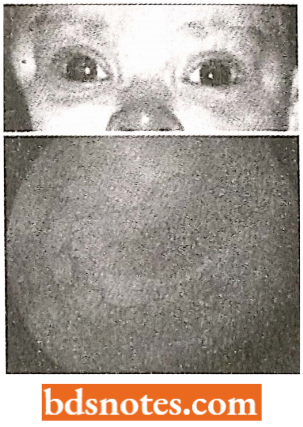 Unilateral Retinoblastoma