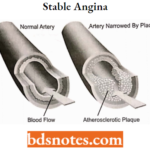 Antianginal Drugs Stable Angina