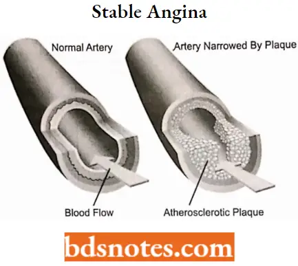 Antianginal Drugs Stable Angina