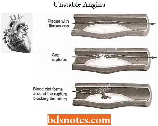Antianginal Drugs Unstable Angina