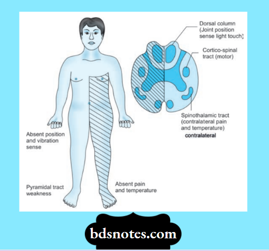 Brown-Sequard syndrome
