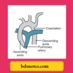 Coarctation of aorta