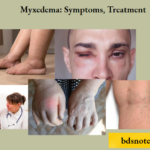 Myxedema Symptoms Treatment