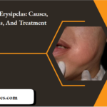Cellulitis Erysipelas Causes, Symptoms, And Treatment
