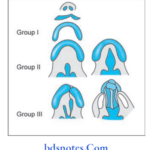 Cleft Palate Classification