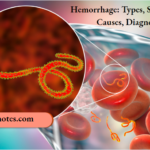 Hemorrhage Types, Symptoms, Causes, Diagnosis