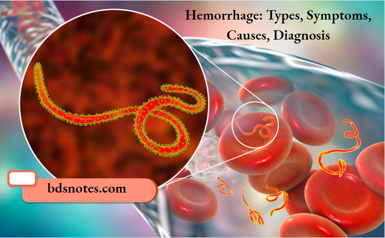 Hemorrhage Types, Symptoms, Causes, Diagnosis