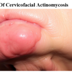 Symptoms Of Cervicofacial Actinomycosis