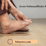 Acute Submandibular Sialadenitis