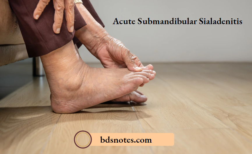 Acute Submandibular Sialadenitis