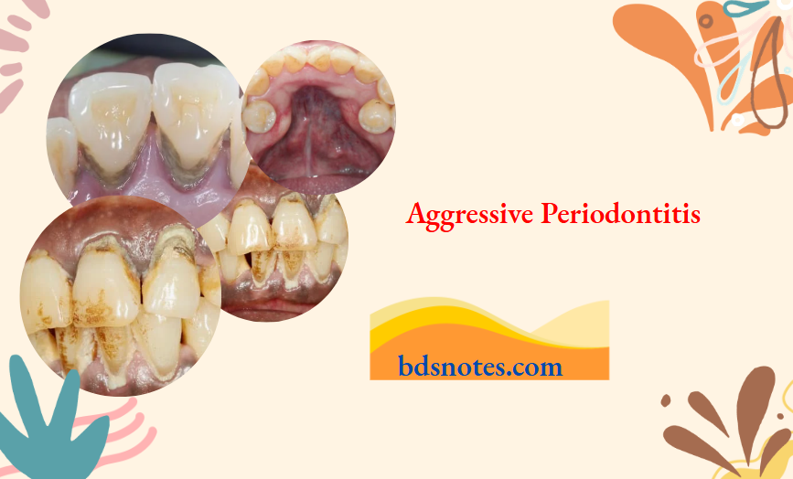 Aggressive Periodontitis