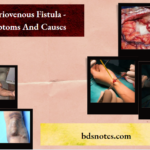 Arteriovenous Fistula - Symptoms And Causes