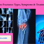 Bone Fractures Types, Symptoms And Treatment