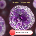 Burkitt Lymphoma