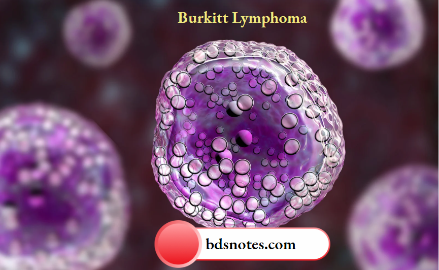 Burkitt Lymphoma