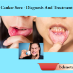 Canker Sore - Diagnosis And Treatment