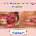 Effects Of Sex Hormones On The Gingiva In Pregnancy