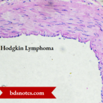 Hodgkin Lymphoma