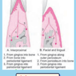 Interproximal Facial Lingual Bone Loss Pathways