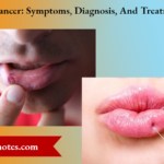Lip Cancer Symptoms, Diagnosis, And Treatment