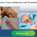 Lipoma Causes, Symptoms, And Treatment