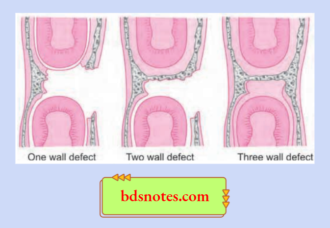Periodontal Bone Defect Types