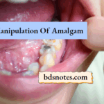 Amalgam Condensation Method