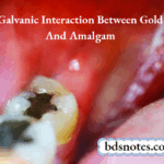 Galvanic Corrosion Gold Vs Amalgam