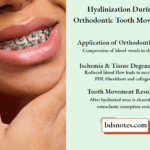 Hyalinization During Orthodontic Tooth Movement